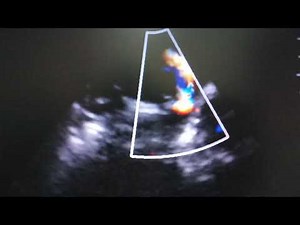 Patent ductus arteriosus (PDA) with bidirectional shunt