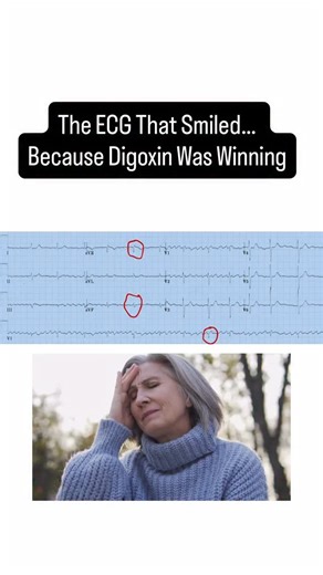 Learn ECGs Fast | JMD Medical Ed on Instagram: "She’s 78. On digoxin. Comes in dizzy, pulse thready. Heart rate? 38. The ECG prints… and it’s smiling but not in a good way. Look closely. Narrow complexes. Regular. No P waves leading them. That’s not sinus. That’s Junctional Bradycardia. And when you see that slow junctional escape at 100 bpm. Same mechanism different speeds. But the cause? The AV node pacing the heart because the SA node failed or was suppressed. And if your patient’s on digoxin