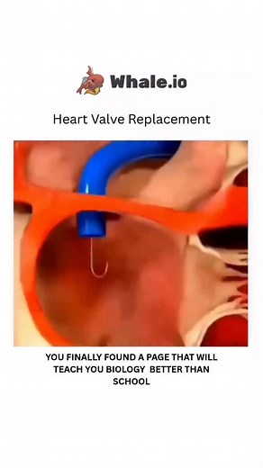 BIOLOGY | HEALTH | MEDICAL on Instagram: "Heart valve replacement is a surgical procedure to replace a diseased or damaged heart valve with an artificial mechanical valve, made from durable materials, or a biological valve, made from human or animal tissue. Mechanical valves last longer but require lifelong blood-thinning medication to prevent clots, while biological valves don't need lifelong blood thinners but eventually wear out and need replacement. The procedure involves stopping the heart,