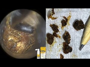 86 - Completely Blocked & Impacted Ear Wax Removal with WAXscope®️