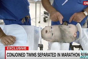 VIDEO: Sijamski blizanci razdvojeni nakon 27-satne operacije u New Yorku
