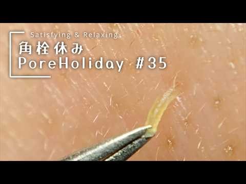 【角栓やすみ / PoreHoliday】スッキリ！ピンセットで角栓抜き #35 【リラックス/Satisfying】