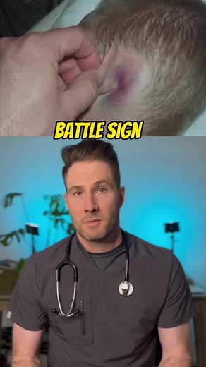 Battle sign for basilar skull fracture. #skullfracture #headinjury #traumaticbraininjury #erdoctor #reels #reelsvideo #reelsinstagram #amazing #tip #dr. #foryou #everyone #doctorlife #doctor #doctorwho | Jonh Andrew