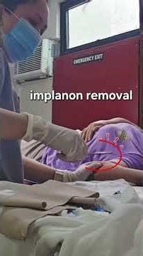 Palpable implanon on the skin removal through small incision
