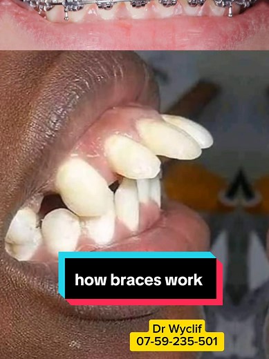 Understanding How Braces Work: A Comprehensive Guide