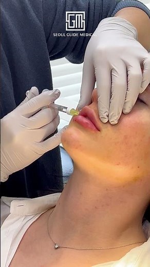 Get that Naturally FULL LIPS with Hyaluronic Acid Filler 👄