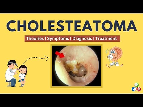 Cholesteatoma - Symptoms, Causes, Theories, Treatment