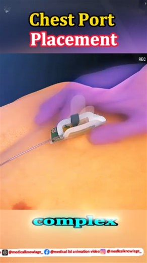medical knowledge on Instagram: "Chest port placement explained in 60 seconds Watch this mind-blowing 3D animation! #MedicalEducation #HealthcareAnimation #Medical3D #ChestPort #PortPlacement #MedicalVideo #HealthcareInfo #PatientEducation #NurseLife #DoctorLife #MedStudent #MedTech #ViralVideo #TrendingReels #ExplorePage #WatchThis #LearnSomethingNew #DidYouKnow #CancerCare #TreatmentJourney #ChemoSupport #HealthcareAwareness"