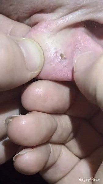 Earlobe Blackhead Extraction: Satisfying Health Tips