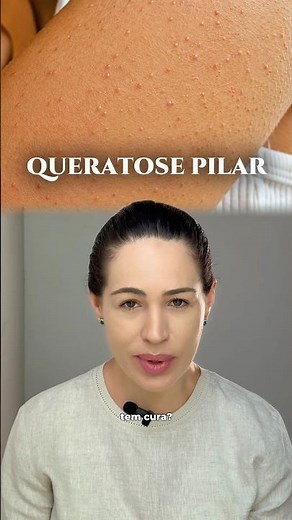 Is Keratosis Pilaris Curable? #dermatologist