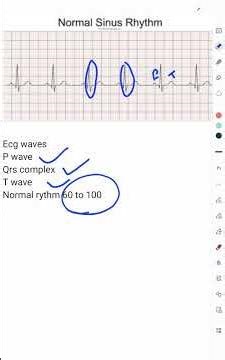 ECG RYTHM # CARDIOLOGY #ecg