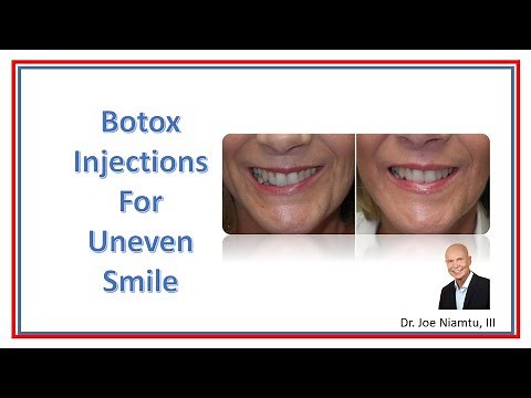 Botox Injections for Uneven Smile