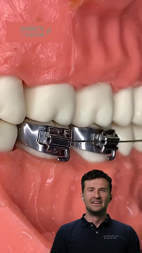 Brackets richtig aufkleben: So funktioniert's!