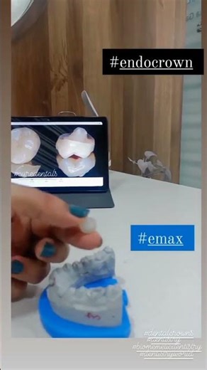 Save Tooth Structure with Endocrown !! #dentist #dentalclinic #dentalcare #dentistry #smilemakeover