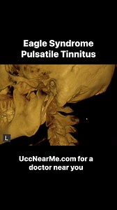 40K views · 196 reactions | 僚Eagle syndrome can leave people suffering with whooshing sounds in the ear, lightheadedness, dizziness, headaches and more. When the stylohyoid ligament calcifies and the upper neck misaligns, it can disrupt blood flow up to the brain and cause these symptoms. Upper cervical care is excellent at helping resolve these symptoms. Comment below for a doctor near you! | Upper Cervical Chiropractor Near Me | Facebook
