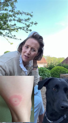 Ticks are everywhere at the moment, especially if you’re walking in long grass, woodland or around animals, so please do be vigilant. Check yourself, your children and your animals regularly after walks or time outdoors. If you do find a tick, remove it carefully using a tick remover if possible. You can also use alcohol or nail varnish remover to help loosen it, but make sure you remove both the body and the head fully. Please also keep an eye on the bite afterwards. If you develop flu-like sym