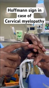 Hoffmann sign in case of cervical myelopathy patient! #spinesurgeon #spine #spinalsurgery