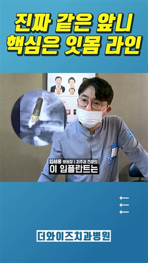 How to avoid front tooth implant failure? Why dentists focus on gums more than teeth... #fronttoo...