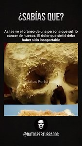 El cáncer de huesos es un tipo de cáncer poco común que se origina directamente en las células óseas. Puede presentarse en cualquier hueso del cuerpo, aunque con más frecuencia aparece en los huesos largos de brazos y piernas. Su causa exacta no siempre se conoce, pero existen factores que aumentan el riesgo, como predisposición genética, radioterapia previa, enfermedades óseas como la de Paget o la propagación de tumores de otros órganos hacia los huesos. Este tipo de cáncer afecta la estructur