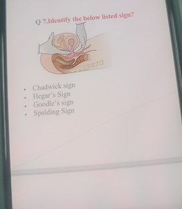 Q 7. Identify the below listed sign?Chadwick signHegar's Sig... | Filo