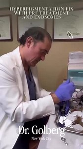 Hyperpigmentation treatment with exosomes   PRF