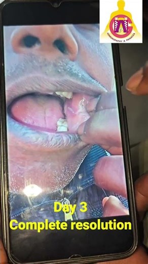 Haemorrhagic Blister Healing in 3 Days | Action of Bellis Perennis