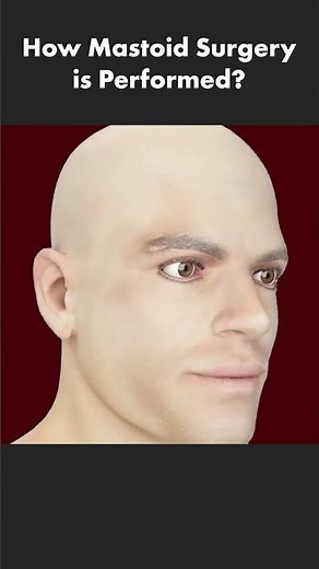 How Mastoid Surgery Is Performed? (Mastoidectomy)