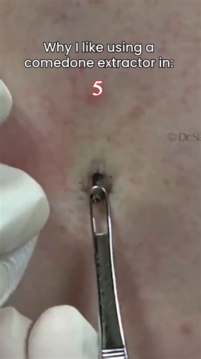 Alright! So many of you have been asking for an explanation on why I use a comedone extractor for many of the extractions on my channel - well, here it is! If you want the one that I use, click here: https://slmdskincare.com/products/extractor-tool Any more questions, drop them in the comments below! #drpimplepopper #popaholics #dermatology #medicaleducation #comedoneextractor #dilatedporeofwiner #blackheads | Dr Sandra Lee aka drpimplepopper