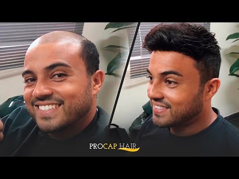 Aplicação de Prótese Capilar Masculina: PROCAP HAIR