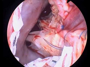 Cormatrix Patch Aortic Root Enlargement  • Video • MEDtube.net