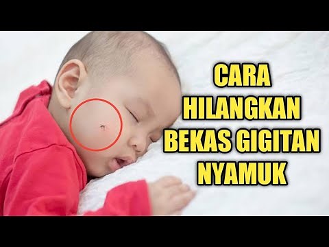How to Quickly Remove Mosquito Bite Marks on Babies