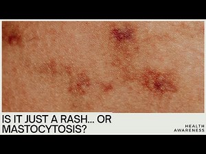 Is It Just a Rash… or the Rare Disorder: Mastocytosis?