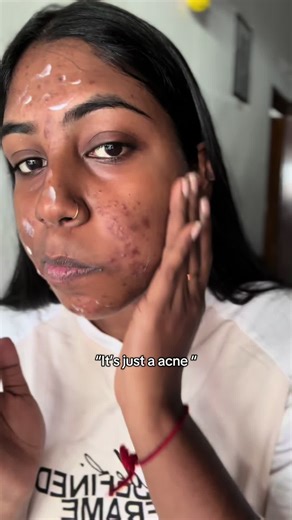 Understanding the Emotional Impact of Acne