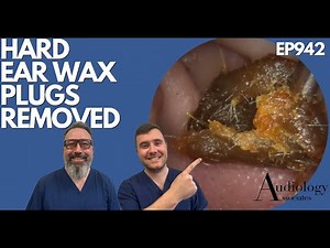 HARD EAR WAX PLUGS REMOVED - EP942