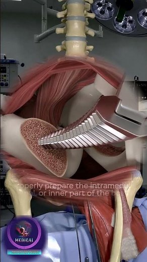 Back on Your Feet Faster: The Direct Anterior Total Hip Replacement 🏃‍♂️✨