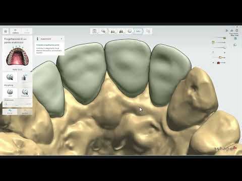 Immediate temporary bridge, after removal of pre-existing crowns.