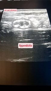 5.5K views · 1.7K reactions | Appendicitis #appendicitis #ultrasonography #dr_wasi_ultrasound #neetpg #medicaleducation #ardms | Ultrasound made easy | Facebook