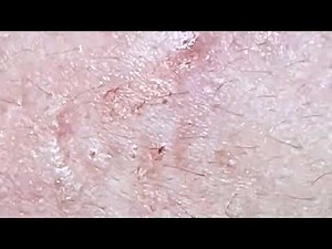 Acne Treatment Nhat Bang #38