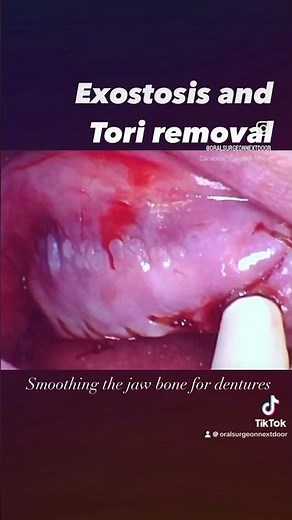 Exostosis and Tori Removal