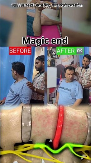 magic end🔥 c5 c6 c7 nerve compression treatment without surgery, disc bulge, chiropractor #shorts