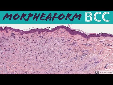Morpheaform Basal Cell Carcinoma: 5-Minute Pathology Pearls