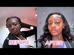 How I Cleared My Acne + Dark Spots + Hyperpigmentation for good (step by step guide)