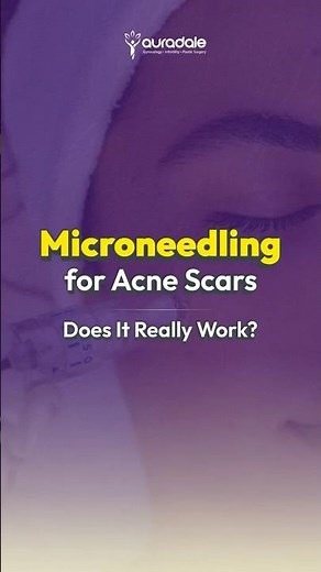 Micro needling for acne scars: Does it really work
