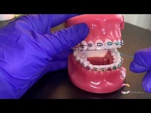 Flossing with Braces: Using a Floss Threader - Dougherty Orthodontics (St. Louis, Missouri)