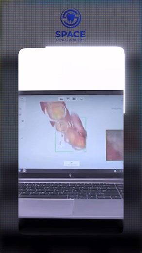 📢✨ Full Fixed Prosthodontics Course – Dr. Tawfik Ramadan ✨📢 🎯 من Basic لحد Advanced… كل حاجة عن الفكسد في كورس واحد شامل مع workshop على أعلى مستوى! كورس الفكسد الاقوي --- 🗓 Day 1 – Diagnosis & Treatment Planning in Fixed Prosthodontics Personal Data & History Taking Chief Complaints Analysis Clinical & Radiographic Examination Abutment Evaluation & Bio-mechanical Considerations Treatment Planning – Special Cases & Challenges Principles of Tooth Preparations: Objectives – Retention & Resista
