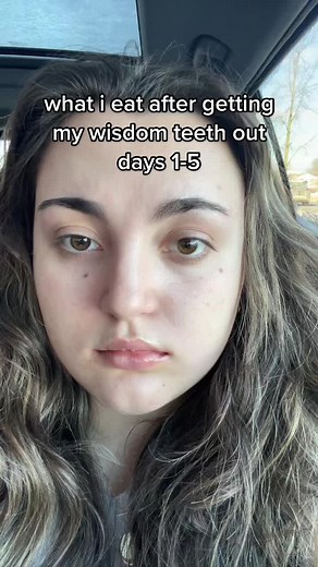 Wisdom Teeth Recovery Foods: What I Ate After Extraction