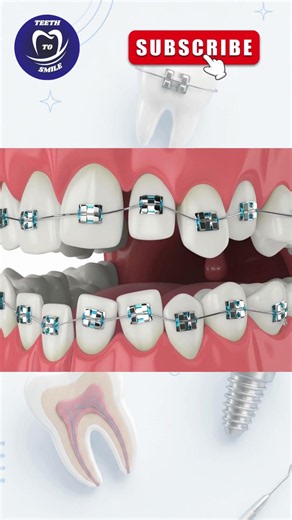 This Is How Braces Are Actually Attached to Your Teeth 😳🦷 #shorts