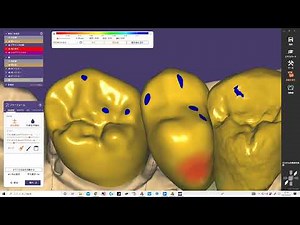 exocad ヘミセクション