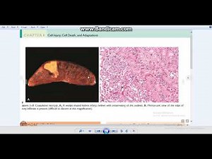 Necrosis Pathology 1