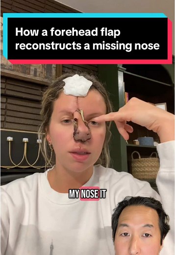 How a nose is reconstructed with a paramedian forehead flap! #foreheadflap #nosereconstruction Video credit: @Shayna Crimo